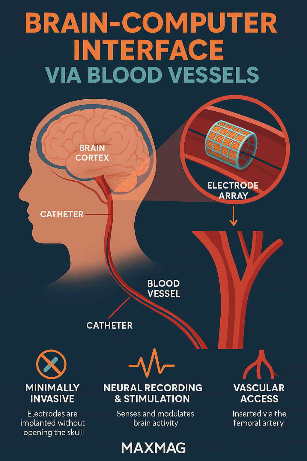 Infographic showing how a brain-computer interface is implemented via blood vessels, with labeled diagrams of the brain, catheter, blood vessel, and electrode array, alongside icons representing minimal invasiveness, neural recording, and vascular access.